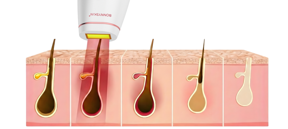 IPL Wirkungsweise Querschnitt