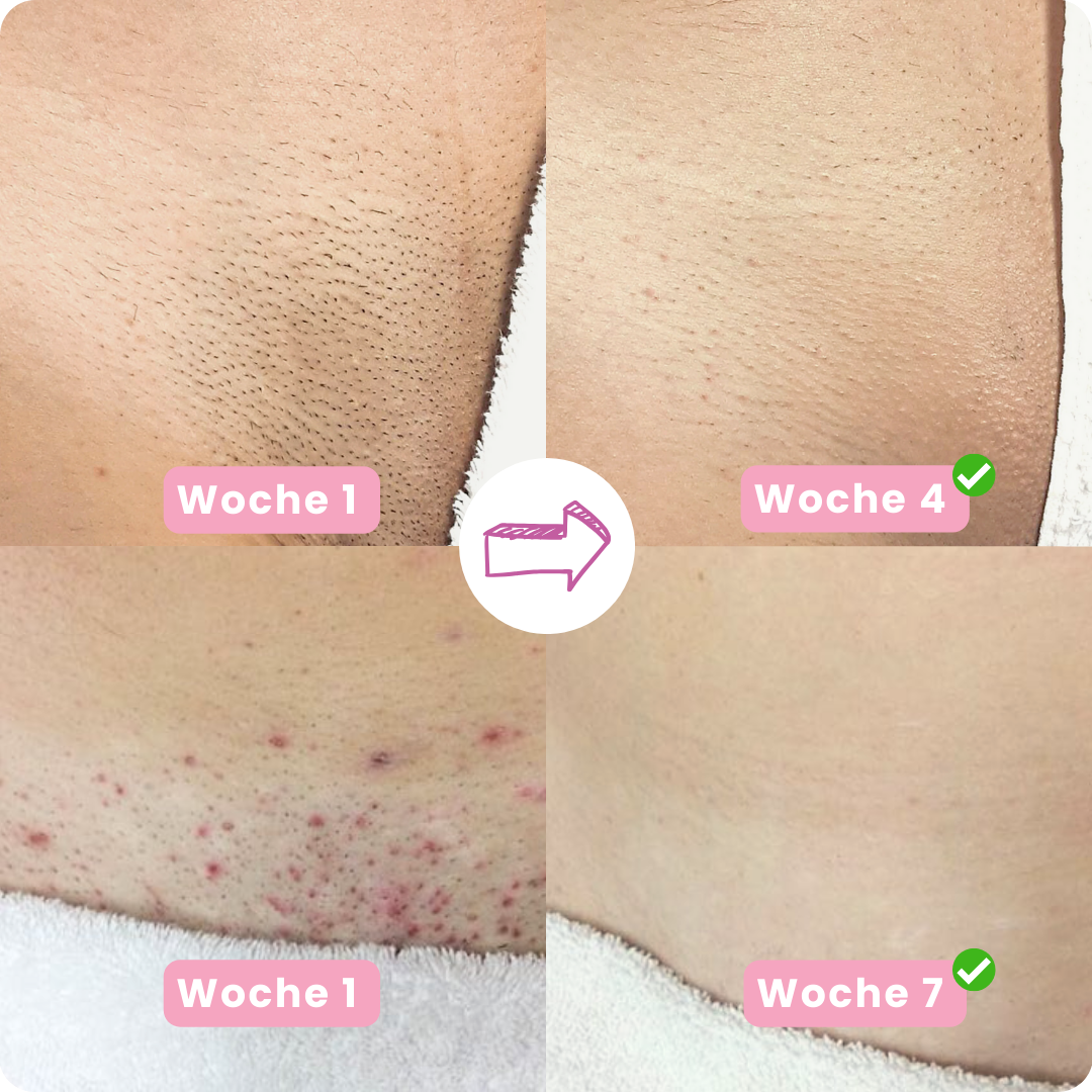 IPL PRO 4 Haarentfernungsgerät