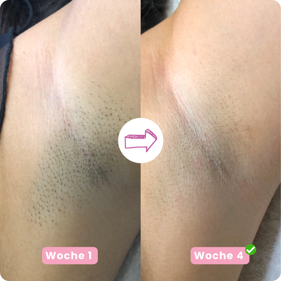 IPL PRO 4 Haarentfernungsgerät