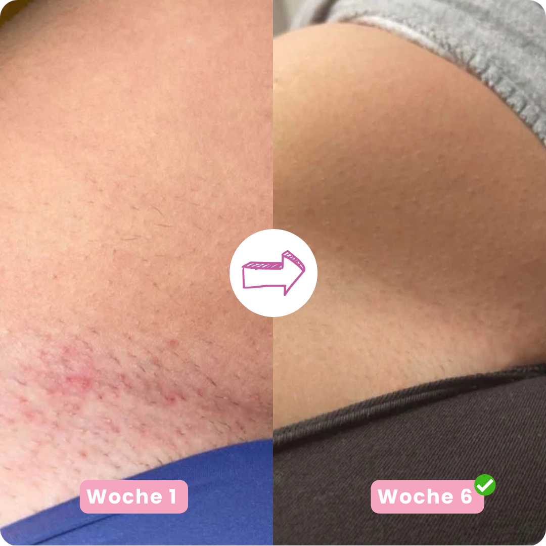 IPL PRO 4 Haarentfernungsgerät